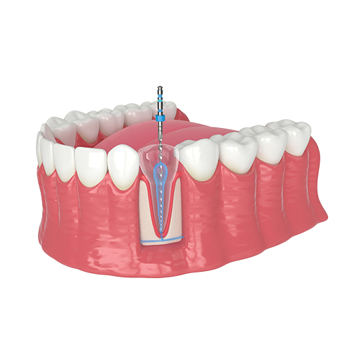 Endodontic Treatment