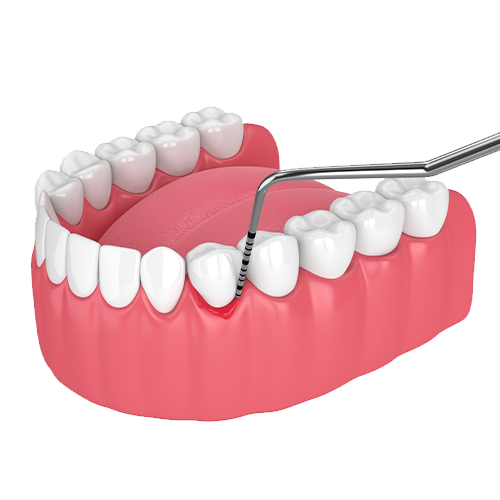 Periodontal Treatment