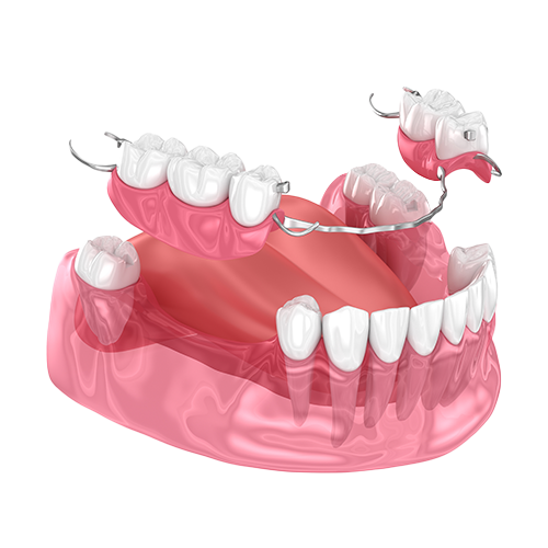 Prosthodontic Treatment